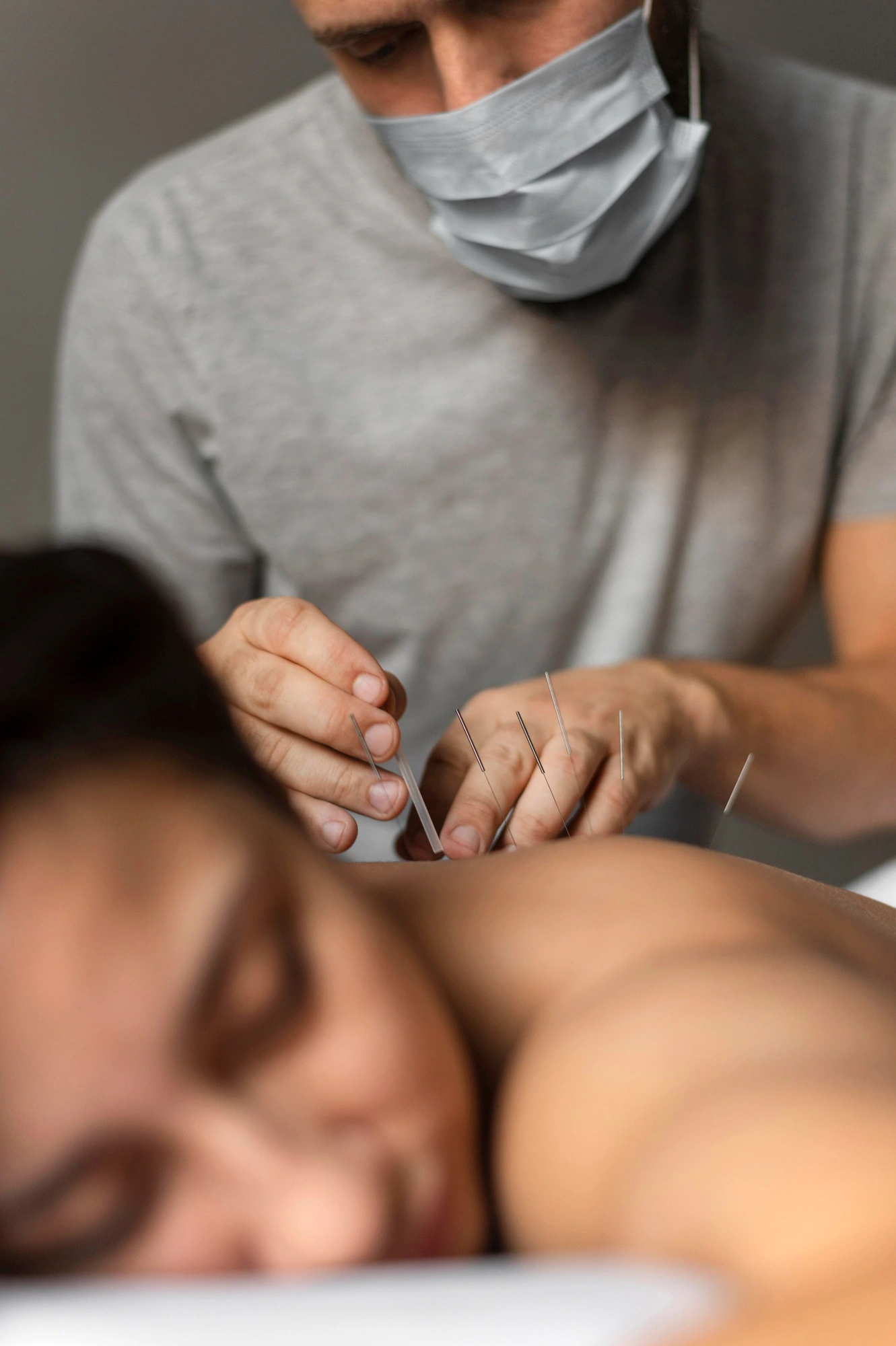 acupunture (1)